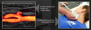 carotid doppler