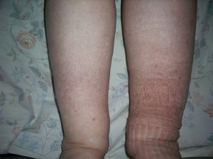 lymphedema 1sml