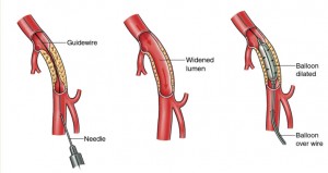 Αγγειοδιαστολή στενωμένης αρτηρίας με μπαλόνι2